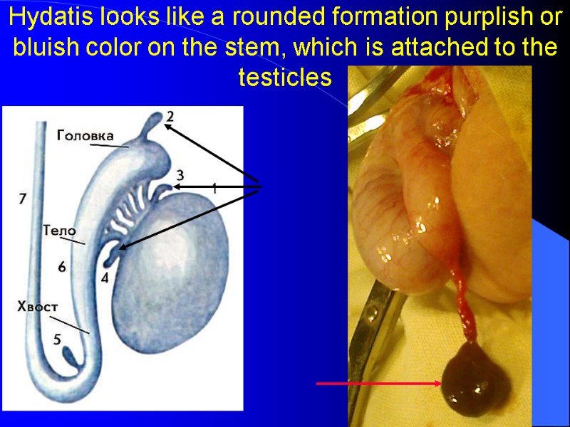 Hydatis looks like a rounded formation purplish or bluish color on the stem, which Hydatis looks like a rounded formation purplish or bluish color on the stem, which